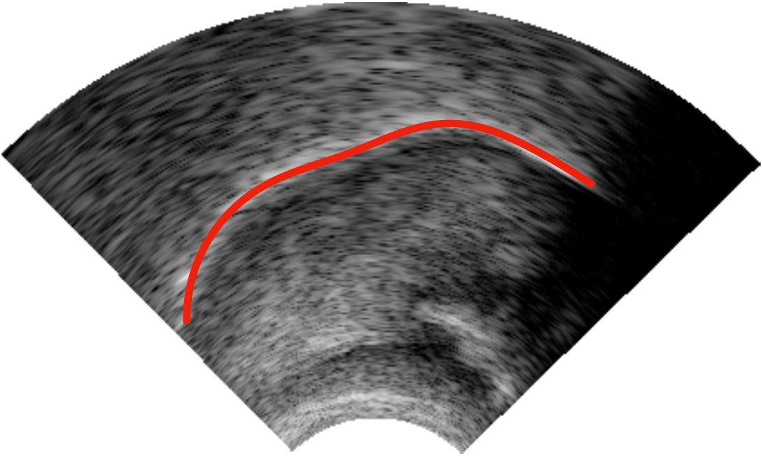 Tongue surface in an ultrasound image