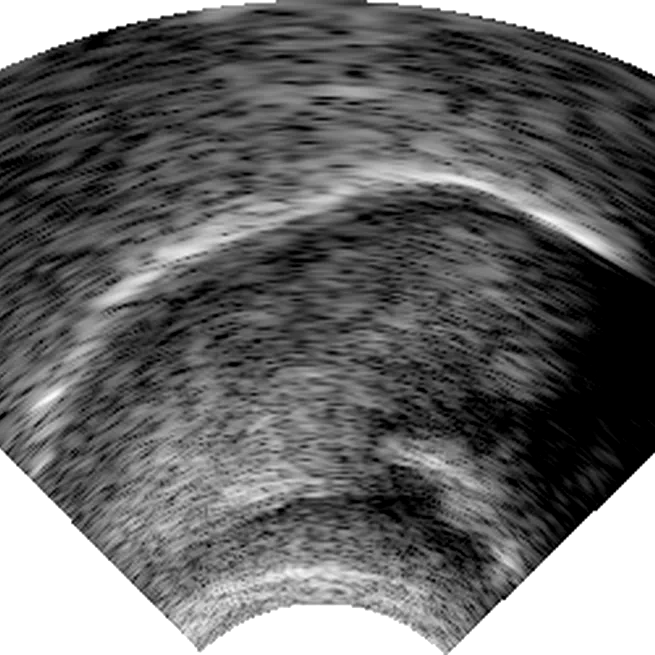 Ultrasound in phonetics