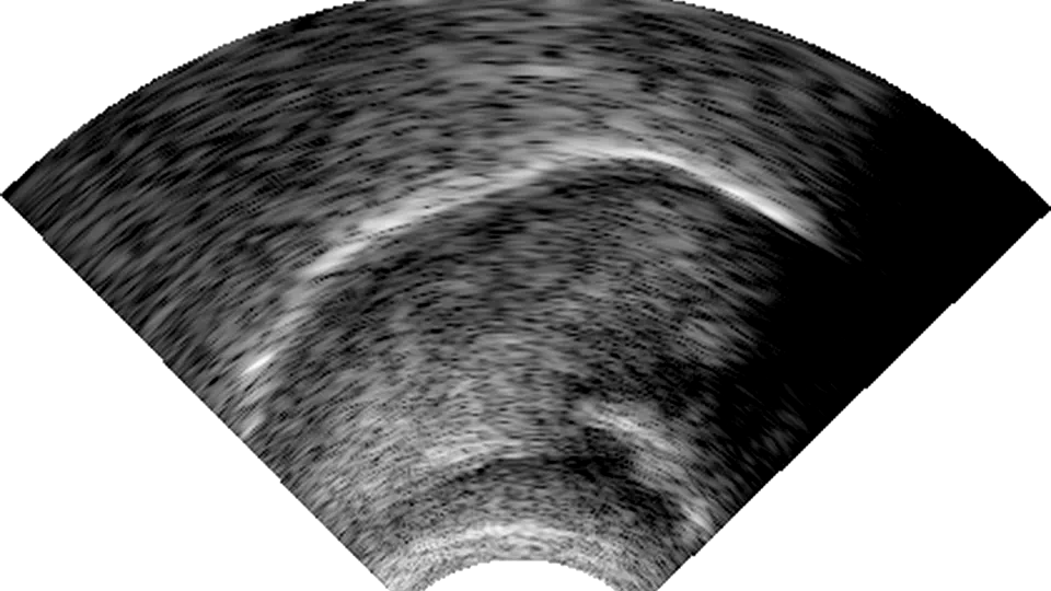 Ultrasound in phonetics